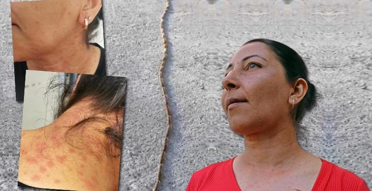 Evini bahçesini temizledi, hastanelik oldu! Yüzü, boynu, gözleri ve kolları kızarıp kabardı