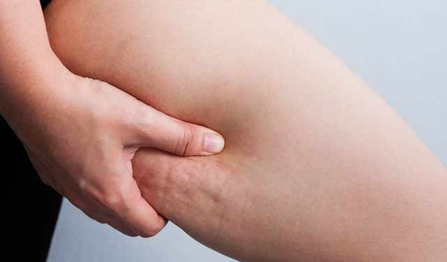 Selülite karşı yepyeni bir tedavi yöntemi: “EnzimatikHA”